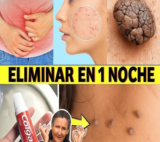 Elimina Verrugas y Lunares con Este Truco Casero De Yodo