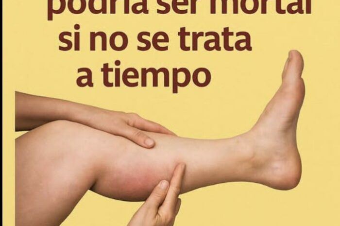 Combatir la Trombosis: Remedios Naturales para tu Salud