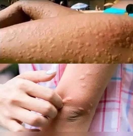 Queratosis pilaris