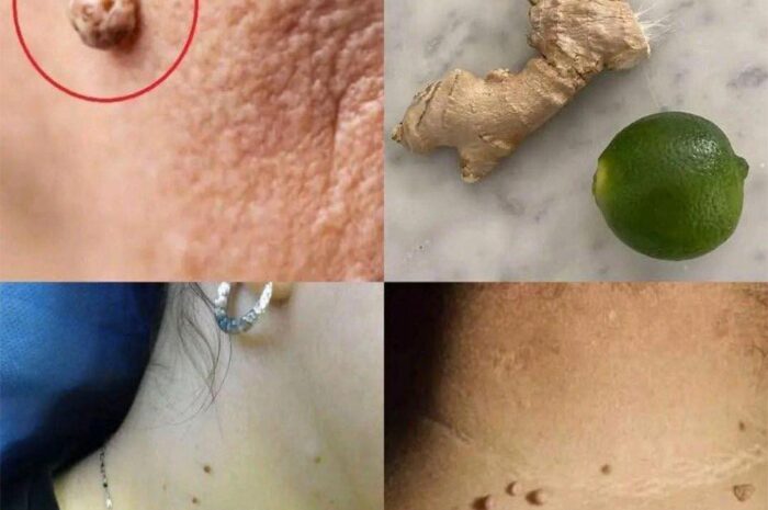 Remedios Naturales para Verrugas: Cómo Hacer Caer las Verrugas con Jengibre y Limón