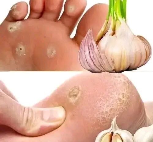 Señales en tus PIES que indican Problemas de Salud y Remedios Naturales