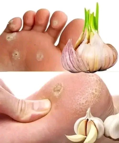 Ajo como remedio natural para verrugas en los pies