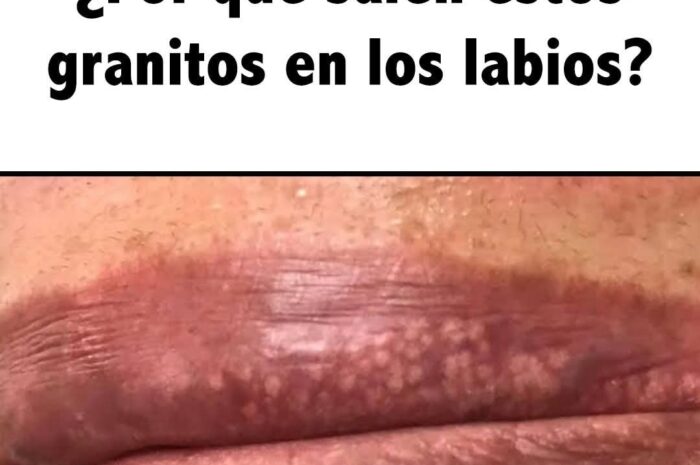 Granitos Blancos en los Labios y Zona Íntima: Causas y Remedios Caseros