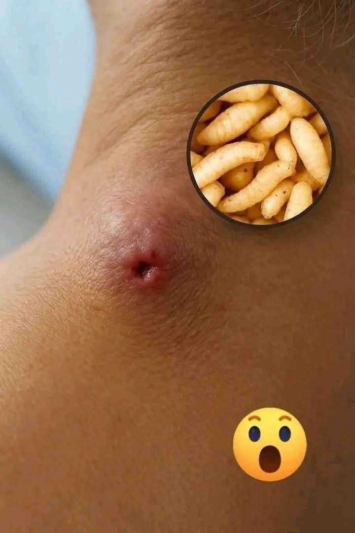 Imagen de infestación parasitaria en la piel