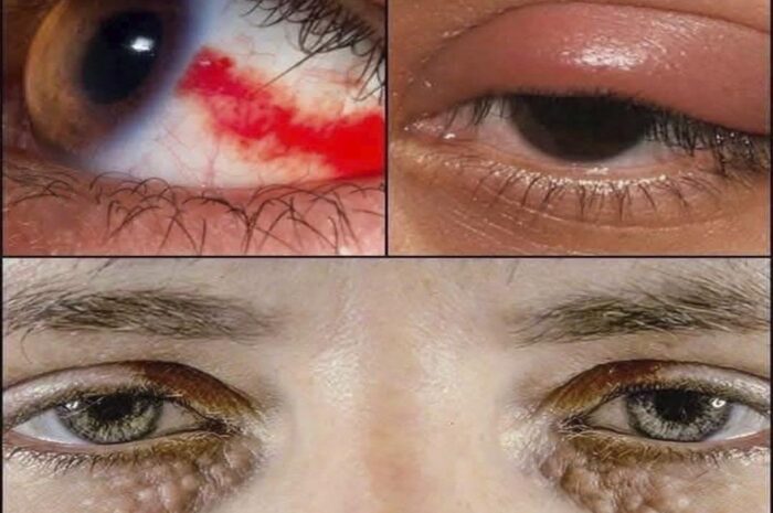 Señales en tus Ojos que Indican Problemas de Salud y Remedios Naturales