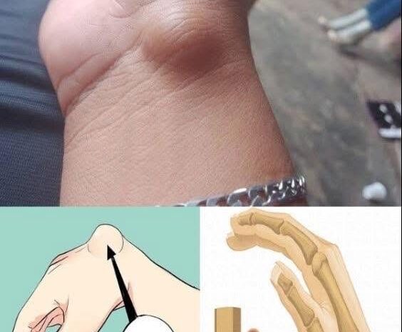 Gangliones: Todo lo que Necesitas Saber sobre este Común Quiste en la Muñeca