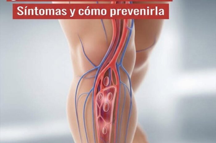 Trombosis: ¿Dolor, Hinchazón o Calor en las Piernas? Lo Que Debes Saber