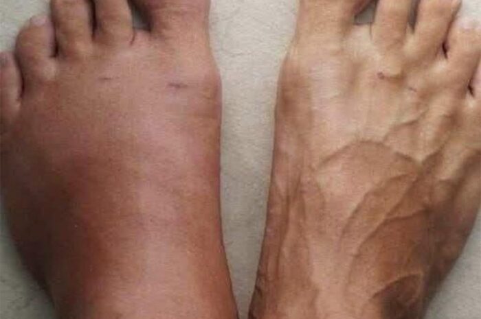 Consecuencias de Dormir con Inflamaciones en los Pies: Remedios Naturales y Consejos de Salud