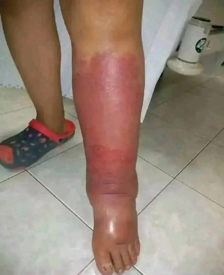 Pierna con inflamación y enrojecimiento