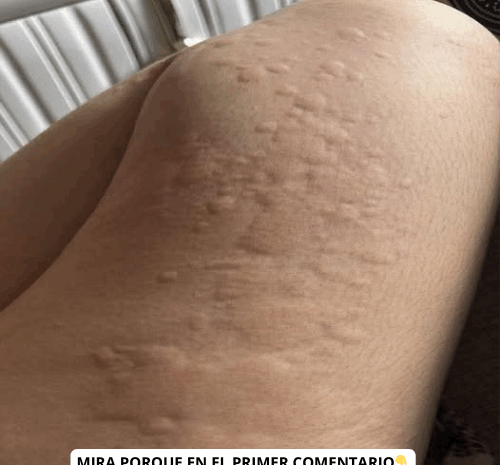 Descubre los Signos de Problemas de Salud en la Piel y Remedios Naturales
