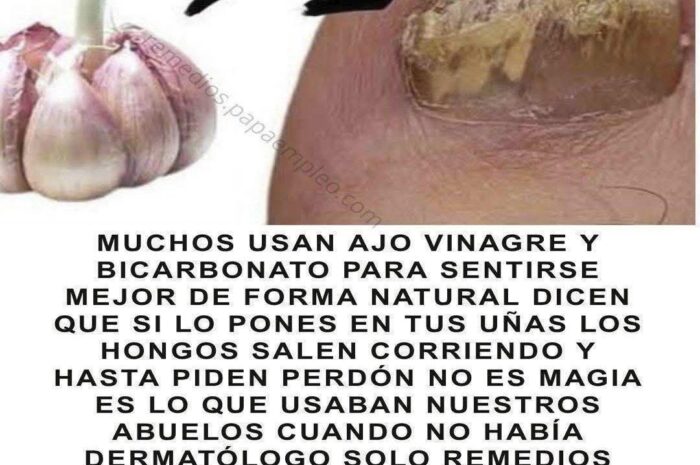 Remedio Casero para Hongos en las Uñas: Ajo, Vinagre y Bicarbonato