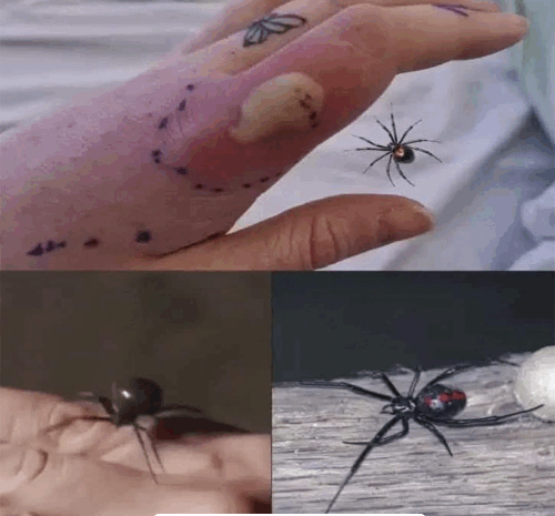 ¿Qué Hacer si Te Muerde una Araña Viuda Negra? Guía Completa de Primeros Auxilios y Remedios Naturales