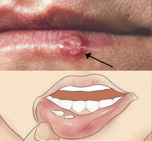 Herpes Labial: Cómo Reconocer y Tratar las Ampollas y Llagas de Forma Eficaz