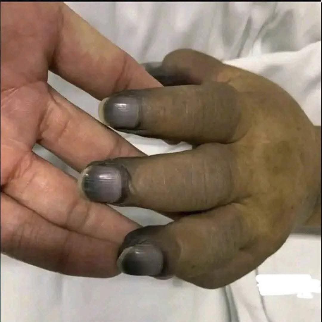 Mano con decoloración en uñas