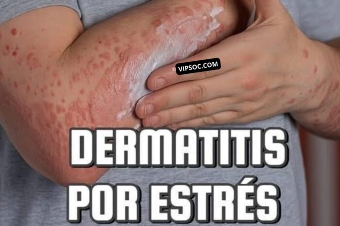 Dermatitis por Estrés: Cómo el Estrés Afecta Nuestra Piel