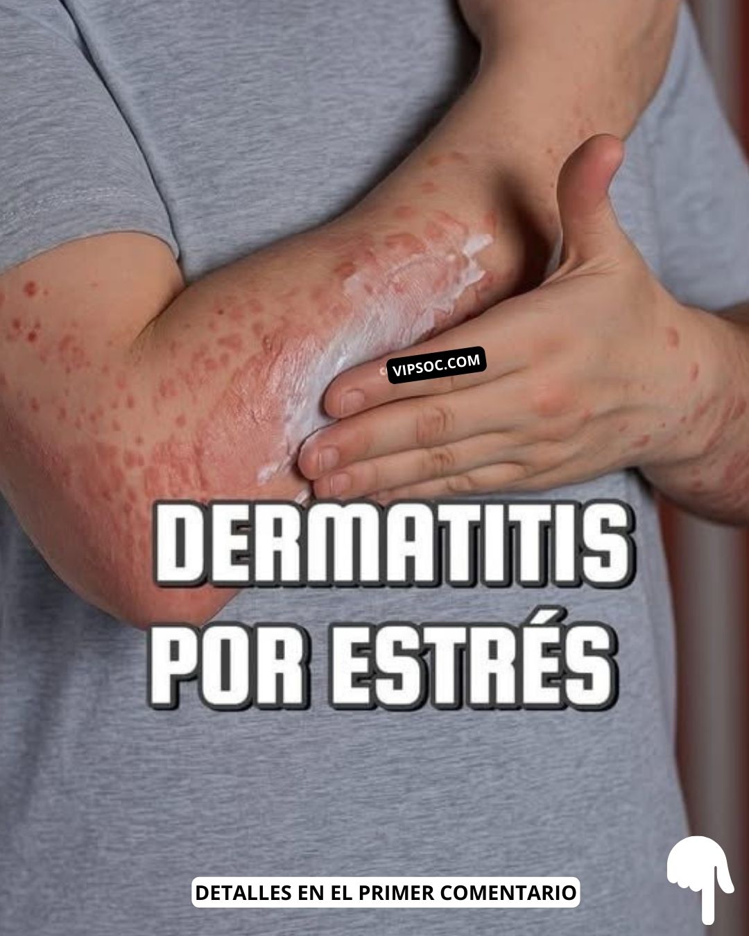 Imagen de una persona aplicándose crema en el brazo afectado por dermatitis