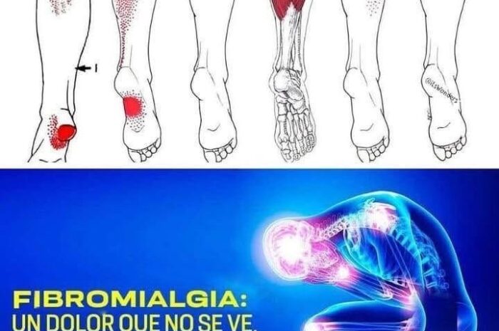 Fibromialgia: Comprendiendo el Dolor Invisible y sus Remedios Naturales