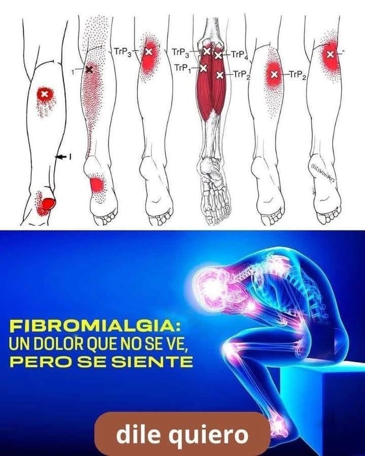 Fibromialgia: dolor que no se ve, pero se siente