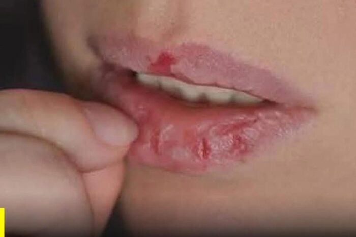 Cuidado de los Labios: Remedios Caseros para Combatir la Resequedad y Cambios de Color