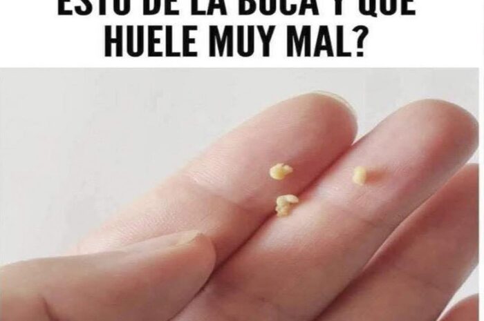 Cómo Eliminar el Mal Aliento: Soluciones Efectivas y Remedios Naturales