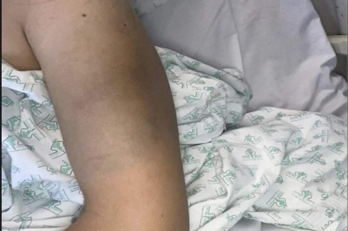 Las Consecuencias de Acostarse con Cuidado: Entendiendo los Hematomas y su Tratamiento Natural