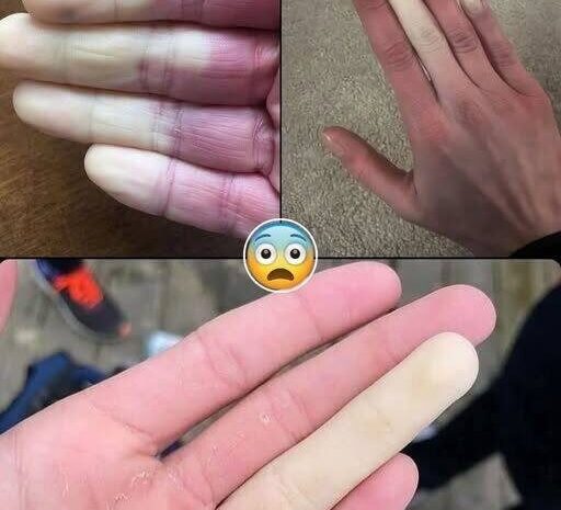 El Fenómeno de Raynaud: Causas, Síntomas y Remedios Naturales