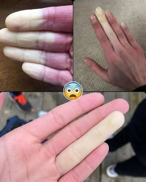 Ejemplo de fenómeno de Raynaud en manos