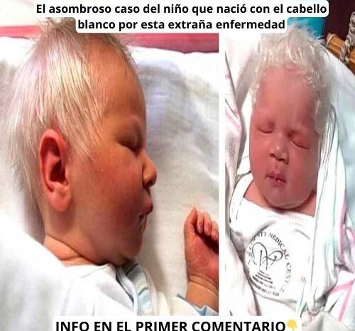 El Asombroso Caso del Niño que Nació con el Cabello Blanco