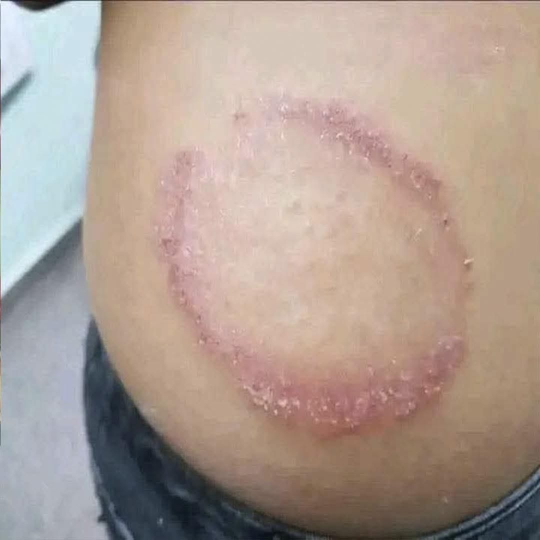 Ejemplo de erupción cutánea