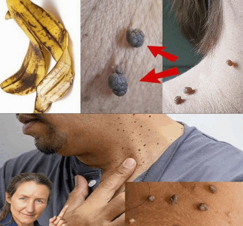 Cómo Eliminar las Etiquetas de Piel en la Cara Naturalmente en Casa