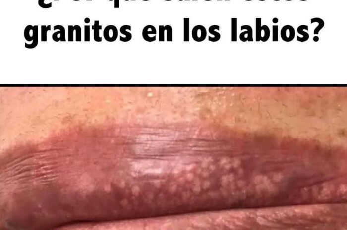 Granitos en los Labios: Causas y Remedios Naturales