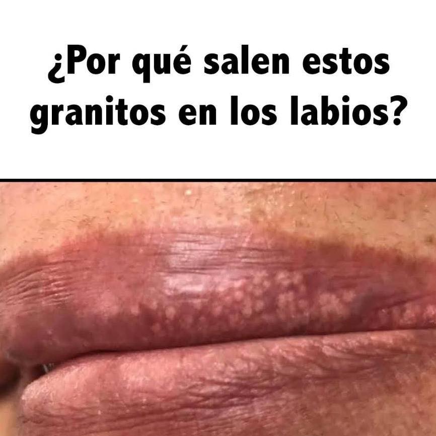 Granitos en los labios