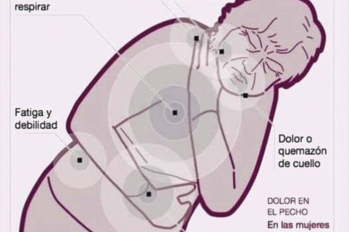 Síntomas Esenciales de Infarto en Mujeres: Lo Que Deberías Saber