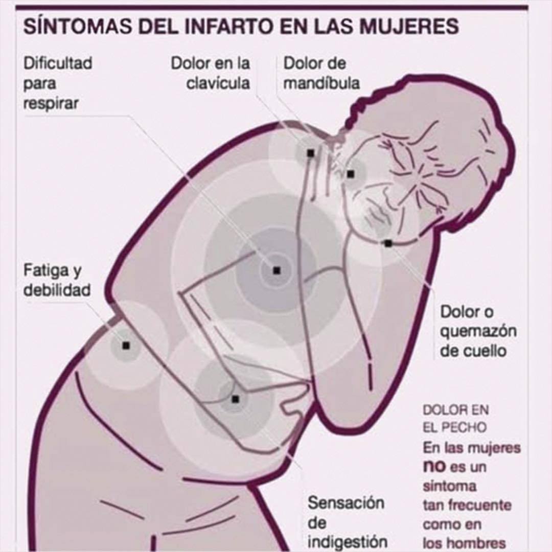 Gráfico de síntomas de infarto en mujeres