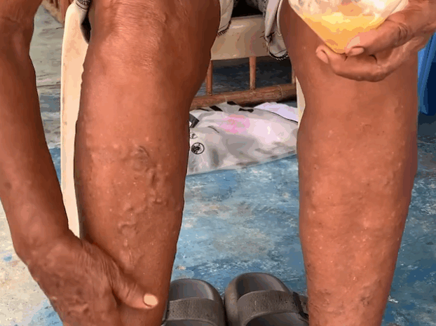 El Cura Pie: El Remedio Natural que Combate la Artritis de Forma Efectiva