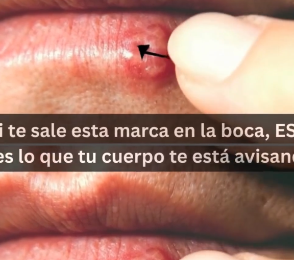 Herpes labial - Tratamiento natural
