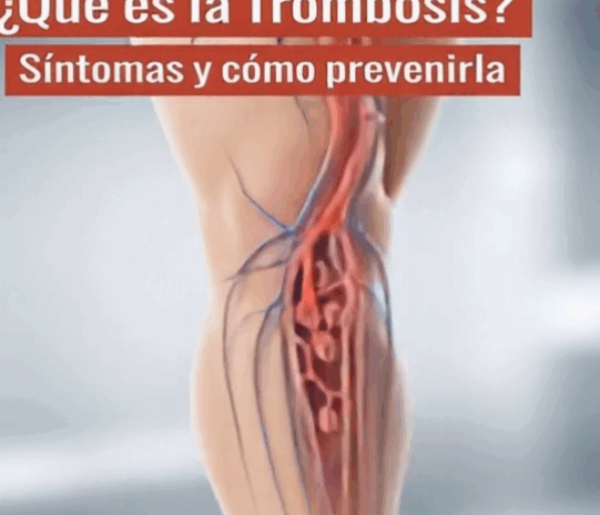 Trombosis: Entendiendo sus Síntomas, Causas y Remedios Naturales