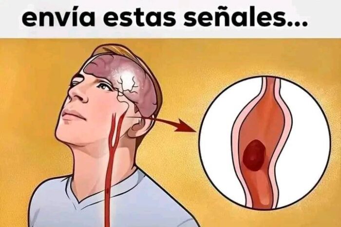 Señales de Alerta: ¿Cómo Reconocer un Derrame Cerebral Antes de que Ocurra?