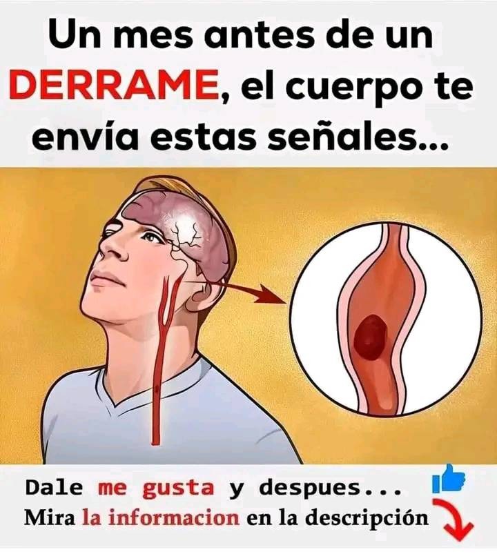 Derrame Cerebral