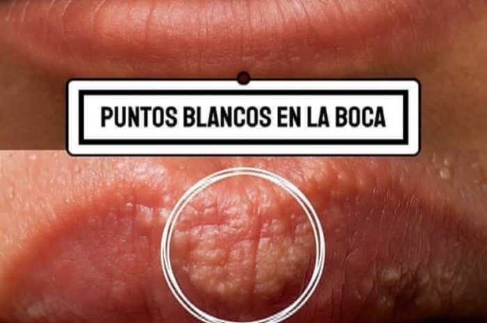 Puntos Blancos en la Boca: Causas y Remedios Naturales