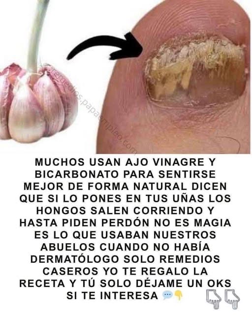 Remedio casero para hongos en las uñas