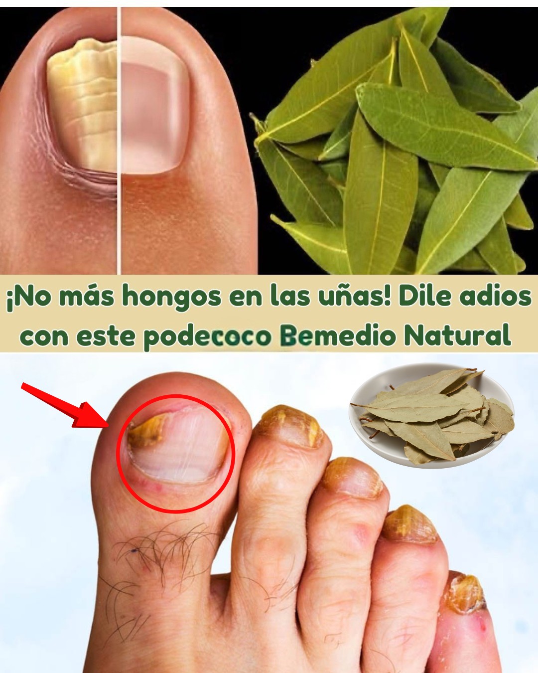Remedio natural con laurel para tratar hongos en las uñas