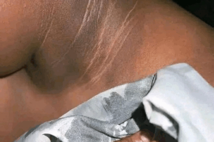 Cómo Combatir el Cuello Negro: Causas y Remedios Naturales