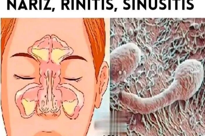 Elimina el Moco, la Flema y Problemas Respiratorios de Manera Natural con Esta Receta Casera