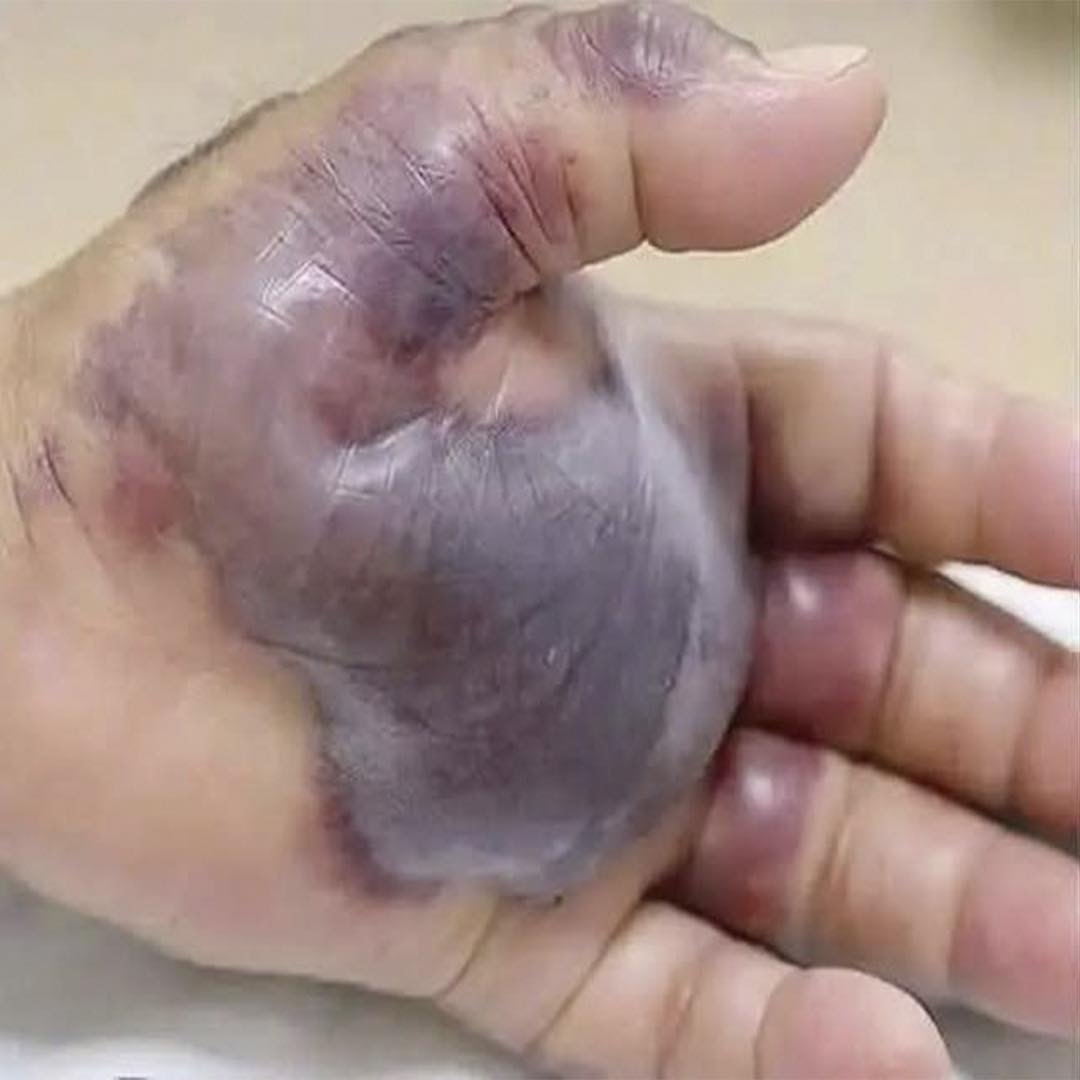 Inflamación de mano