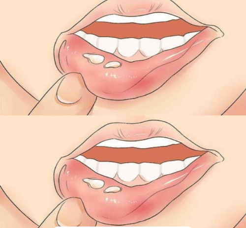 Herpes Labial: Ampollas y Llagas, Qué Hacer y Cómo Curarlas