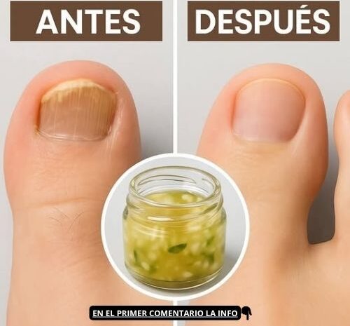 Eliminación Rápida de Hongos del Pie: Un Remedio Natural Eficaz