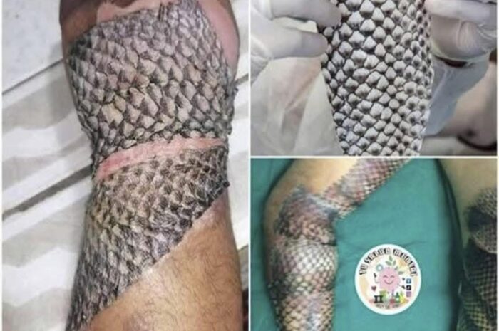 La Innovación en Cicatrización: Piel de Tilapia en Tratamientos de Quemaduras