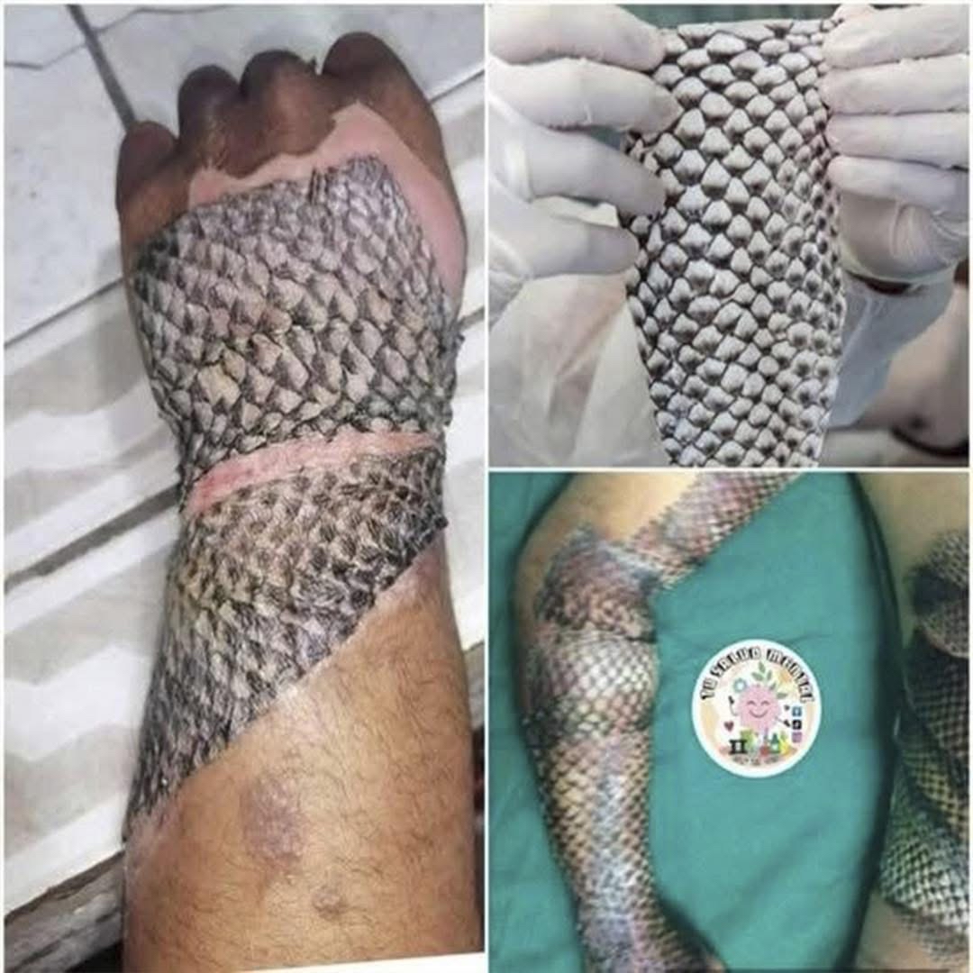 Piel de tilapia en tratamiento de heridas