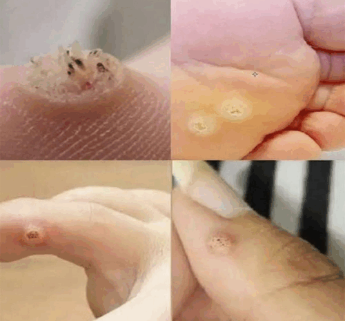 ¡Mucho Cuidado! Identifica y Trata las Verrugas de Manera Natural